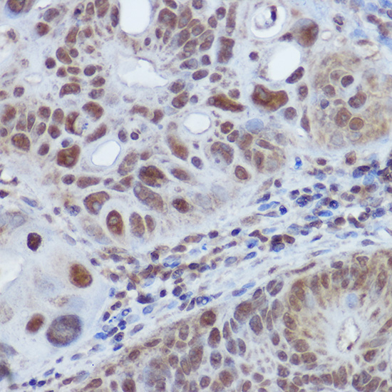 Immunohistochemistry of paraffin-embedded human colon carcinoma using RBMY1A1 Polyclonal Antibody at dilution of 1:100 (40x lens).Perform high pressure antigen retrieval with 10 mM citrate buffer pH 6.0 before commencing with IHC staining protocol.