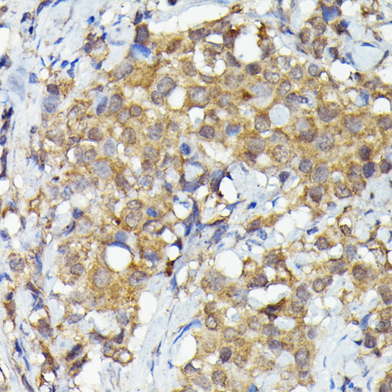 Immunohistochemistry of paraffin-embedded human breast cancer using MKNK1 Polyclonal Antibody at dilution of 1:50 (40x lens).Perform high pressure antigen retrieval with 10 mM citrate buffer pH 6.0 before commencing with IHC staining protocol.