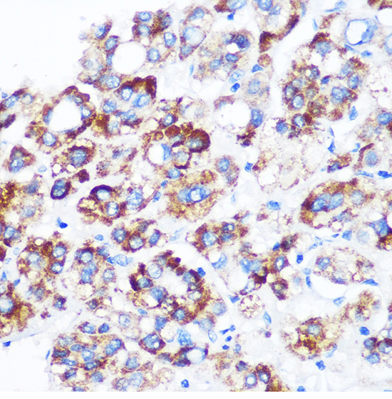 Immunohistochemistry of paraffin-embedded Human liver cancer using C9orf114 Polyclonal Antibody at dilution of 1:100 (40x lens).Perform microwave antigen retrieval with 10 mM PBS buffer pH 7.2 before commencing with IHC staining protocol.