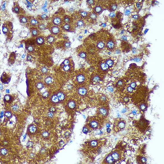 Immunohistochemistry of paraffin-embedded Human liver cancer using PIGU Polyclonal Antibody at dilution of 1:100 (40x lens).Perform microwave antigen retrieval with 10 mM PBS buffer pH 7.2 before commencing with IHC staining protocol.