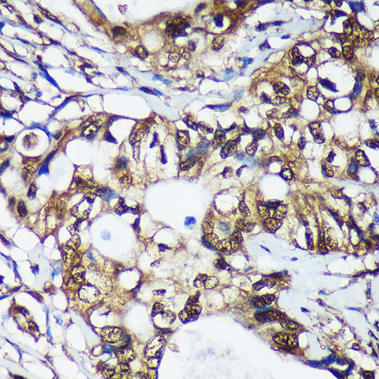 Immunohistochemistry of paraffin-embedded Human colon carcinoma using TSN Polyclonal Antibody at dilution of 1:100 (40x lens).Perform microwave antigen retrieval with 10 mM PBS buffer pH 7.2 before commencing with IHC staining protocol.