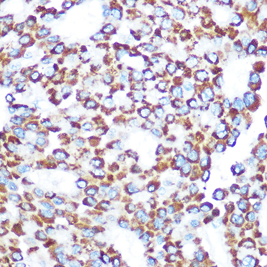 Immunohistochemistry of paraffin-embedded human liver cancer using TAB3 Polyclonal Antibody at dilution of 1:100 (40x lens).Perform microwave antigen retrieval with 10 mM Tris/EDTA buffer pH 9.0 before commencing with IHC staining protocol.