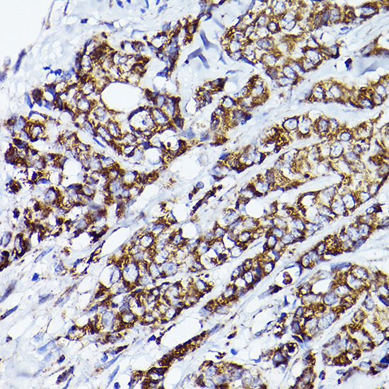 Immunohistochemistry of paraffin-embedded human breast cancer using VDAC2 Polyclonal Antibody at dilution of 1:100 (40x lens).Perform high pressure antigen retrieval with 10 mM citrate buffer pH 6.0 before commencing with IHC staining protocol.