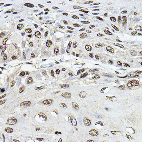 Immunohistochemistry of paraffin-embedded human esophageal cancer using TRRAP Polyclonal Antibody at dilution of 1:100 (40x lens).Perform microwave antigen retrieval with 10 mM PBS buffer pH 7.2 before commencing with IHC staining protocol.