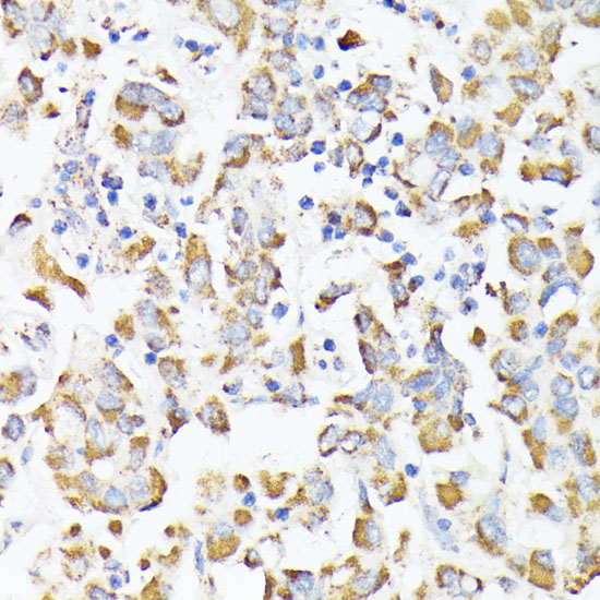 Immunohistochemistry of paraffin-embedded human liver cancer using RHOG Polyclonal Antibody at dilution of 1:100 (40x lens).Perform microwave antigen retrieval with 10 mM PBS buffer pH 7.2 before commencing with IHC staining protocol.