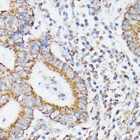 Immunohistochemistry of paraffin-embedded human colon carcinoma using RHOG Polyclonal Antibody at dilution of 1:100 (40x lens).Perform microwave antigen retrieval with 10 mM PBS buffer pH 7.2 before commencing with IHC staining protocol.