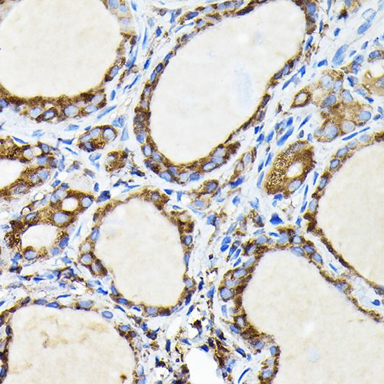 Immunohistochemistry of paraffin-embedded human thyroid cancer using FAM117A Polyclonal Antibody at dilution of 1:100 (40x lens).Perform high pressure antigen retrieval with 10 mM citrate buffer pH 6.0 before commencing with IHC staining protocol.