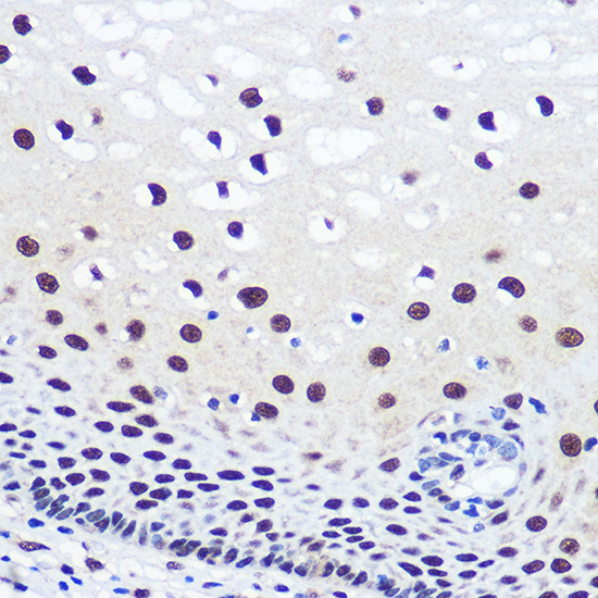 Immunohistochemistry of paraffin-embedded human esophageal using JMJD1C Polyclonal Antibody at dilution of 1:100 (40x lens).Perform microwave antigen retrieval with 10 mM PBS buffer pH 7.2 before commencing with IHC staining protocol.