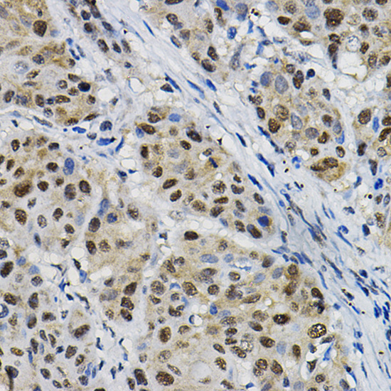 Immunohistochemistry of paraffin-embedded human esophageal cancer using DNAJC17 Polyclonal Antibody at dilution of 1:20 (40x lens).Perform high pressure antigen retrieval with 10 mM citrate buffer pH 6.0 before commencing with IHC staining protocol.