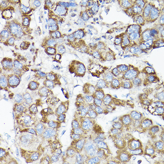 Immunohistochemistry of paraffin-embedded human liver cancer using LLGL1 Polyclonal Antibody at dilution of 1:50 (40x lens).Perform high pressure antigen retrieval with 10 mM citrate buffer pH 6.0 before commencing with IHC staining protocol.