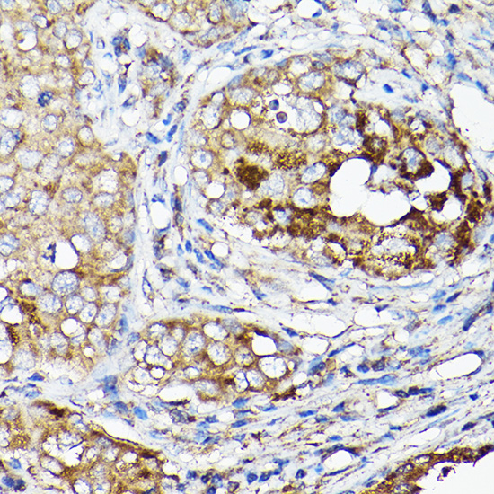 Immunohistochemistry of paraffin-embedded human breast cancer using LLGL1 Polyclonal Antibody at dilution of 1:50 (40x lens).Perform high pressure antigen retrieval with 10 mM citrate buffer pH 6.0 before commencing with IHC staining protocol.