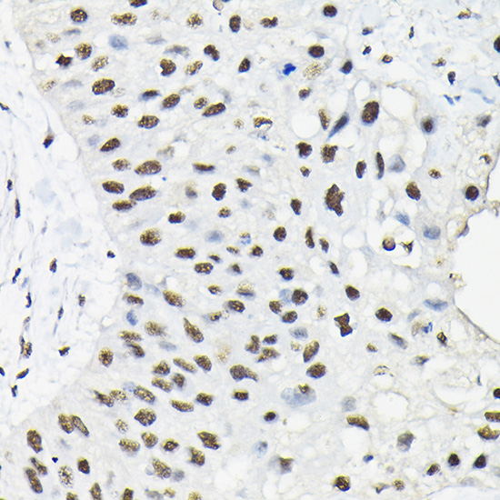 Immunohistochemistry of paraffin-embedded human lung cancer using HNRNPA3 Polyclonal Antibody at dilution of 1:100 (40x lens).Perform high pressure antigen retrieval with 10 mM citrate buffer pH 6.0 before commencing with IHC staining protocol.