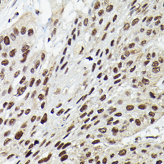 Immunohistochemistry of paraffin-embedded human esophageal cancer using Fam50b Polyclonal Antibody at dilution of 1:50 (40x lens).Perform high pressure antigen retrieval with 10 mM citrate buffer pH 6.0 before commencing with IHC staining protocol.