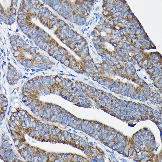 Immunohistochemistry of paraffin-embedded human colon carcinoma using Nesprin 1 Polyclonal Antibody at dilution of 1:100 (40x lens).Perform high pressure antigen retrieval with 10 mM citrate buffer pH 6.0 before commencing with IHC staining protocol.