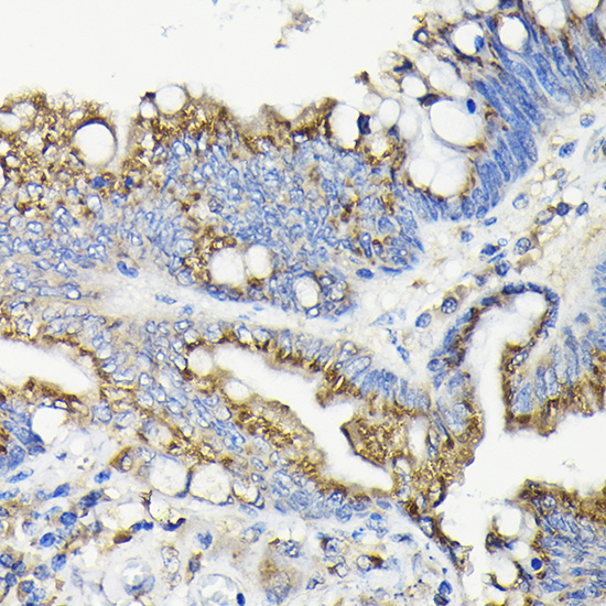 Immunohistochemistry of paraffin-embedded human colon carcinoma using GALNT7 Polyclonal Antibody at dilution of 1:100 (40x lens).Perform high pressure antigen retrieval with 10 mM citrate buffer pH 6.0 before commencing with IHC staining protocol.