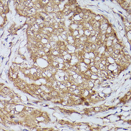 Immunohistochemistry of paraffin-embedded human breast cancer using Slc39a11 Polyclonal Antibody at dilution of 1:100 (40x lens).Perform high pressure antigen retrieval with 10 mM citrate buffer pH 6.0 before commencing with IHC staining protocol.