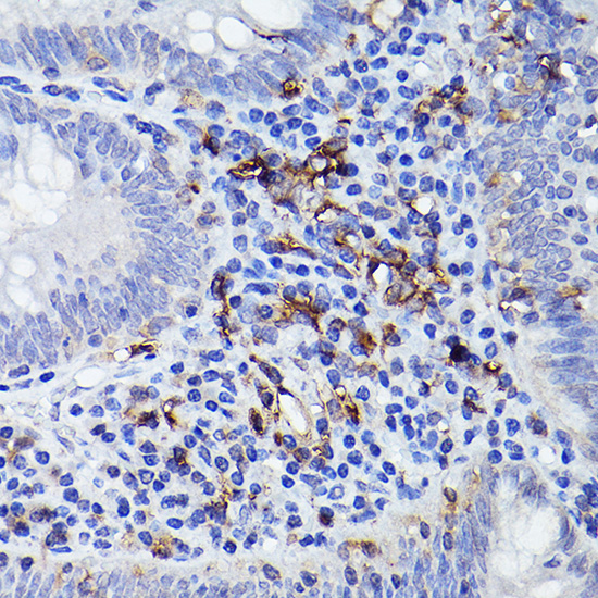 Immunohistochemistry of paraffin-embedded human colon carcinoma using HLA-DQB1 Polyclonal Antibody at dilution of 1:100 (40x lens).Perform high pressure antigen retrieval with 10 mM citrate buffer pH 6.0 before commencing with IHC staining protocol.