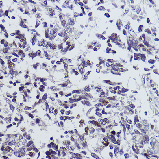 Immunohistochemistry of paraffin-embedded human small cell lung cancer using INSM1 Polyclonal Antibody at dilution of 1:100 (40x lens).Perform high pressure antigen retrieval with 10 mM citrate buffer pH 6.0 before commencing with IHC staining protocol.