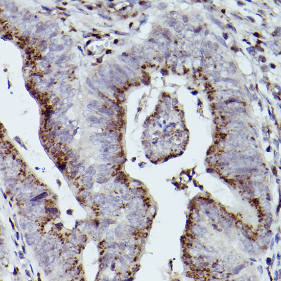 Immunohistochemistry of paraffin-embedded human colon carcinoma using GOLGB1 Polyclonal Antibody at dilution of 1:100 (40x lens).Perform high pressure antigen retrieval with 10 mM citrate buffer pH 6.0 before commencing with IHC staining protocol.