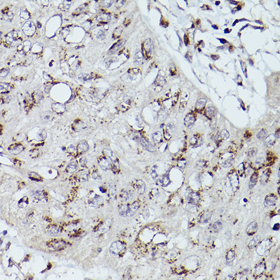 Immunohistochemistry of paraffin-embedded human esophageal cancer using GOLGB1 Polyclonal Antibody at dilution of 1:100 (40x lens).Perform high pressure antigen retrieval with 10 mM citrate buffer pH 6.0 before commencing with IHC staining protocol.