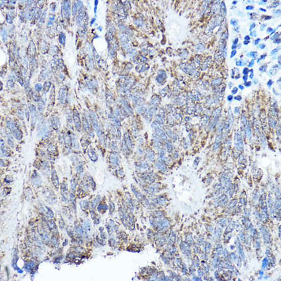 Immunohistochemistry of paraffin-embedded human colon carcinoma using SMOC1 Polyclonal Antibody at dilution of 1:200 (40x lens).Perform high pressure antigen retrieval with 10 mM citrate buffer pH 6.0 before commencing with IHC staining protocol.