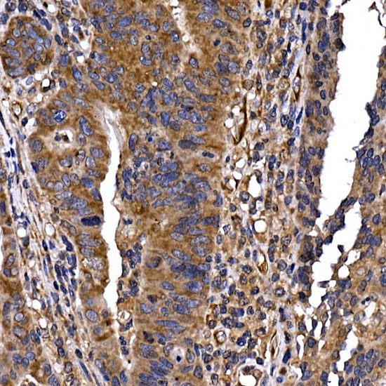 Immunohistochemistry of paraffin-embedded human colon carcinoma using DYNC1LI2 Polyclonal Antibody at dilution of 1:20 (40x lens).Perform high pressure antigen retrieval with 10 mM citrate buffer pH 6.0 before commencing with IHC staining protocol.