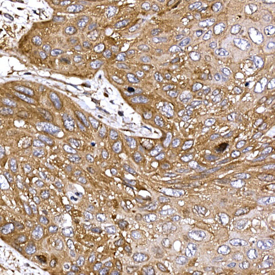 Immunohistochemistry of paraffin-embedded human esophageal cancer using DYNC1LI2 Polyclonal Antibody at dilution of 1:20 (40x lens).Perform high pressure antigen retrieval with 10 mM citrate buffer pH 6.0 before commencing with IHC staining protocol.