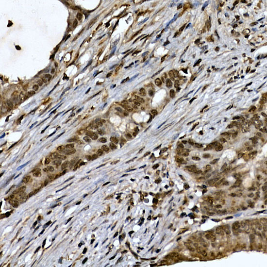 Immunohistochemistry of paraffin-embedded human colon carcinoma using ZNF213 Polyclonal Antibody atdilution of 1:100 (40x lens).Perform high pressure antigen retrieval with 10 mM citrate buffer pH 6.0 before commencing with IHC staining protocol.