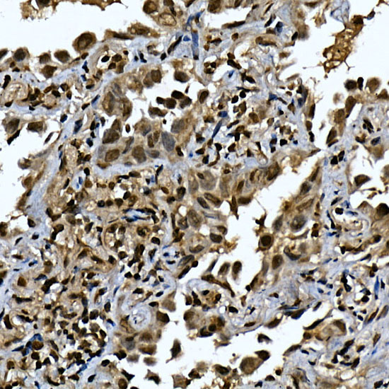 Immunohistochemistry of paraffin-embedded human lung cancer using ZNF213 Polyclonal Antibody at dilution of 1:100 (40x lens).Perform high pressure antigen retrieval with 10 mM citrate buffer pH 6.0 before commencing with IHC staining protocol.