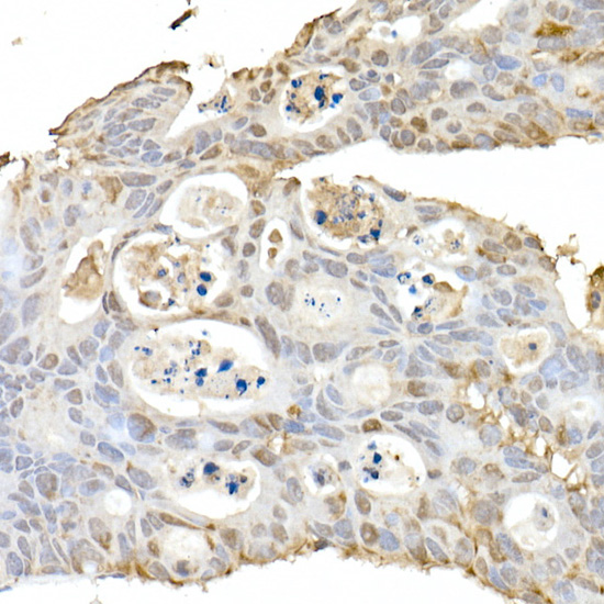 Immunohistochemistry of paraffin-embedded human colon carcinoma using HSP70 Polyclonal Antibody at dilution of 1:100 (40x lens).Perform high pressure antigen retrieval with 10 mM citrate buffer pH 6.0 before commencing with IHC staining protocol.