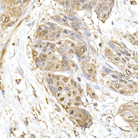 Immunohistochemistry of paraffin-embedded human esophageal cancer using HSP70 Polyclonal Antibody at dilution of 1:100 (40x lens).Perform high pressure antigen retrieval with 10 mM citrate buffer pH 6.0 before commencing with IHC staining protocol.