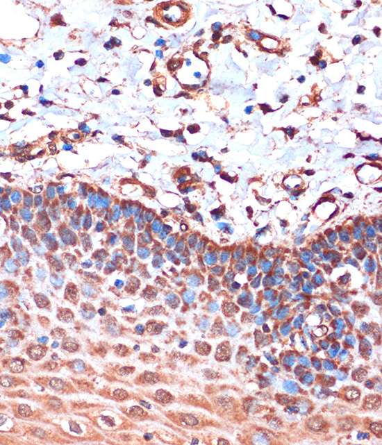 Immunohistochemistry of paraffin-embedded Human esophageal using HIBADH Polyclonal Antibody at dilution of 1:100 (40x lens).Perform microwave antigen retrieval with 10 mM PBS buffer pH 7.2 before commencing with IHC staining protocol.