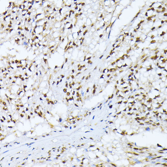 Immunohistochemistry of paraffin-embedded human gastric cancer using Casein Kinase 2 alpha Polyclonal Antibody at dilution of 1:100 (40x lens).Perform microwave antigen retrieval with 10 mM PBS buffer pH 7.2 before commencing with IHC staining protocol.