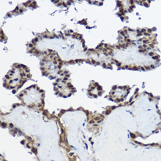 Immunohistochemistry of paraffin-embedded human thyroid cancer using CSTB Polyclonal Antibody at dilution of 1:100 (40x lens).Perform high pressure antigen retrieval with 10 mM citrate buffer pH 6.0 before commencing with IHC staining protocol.