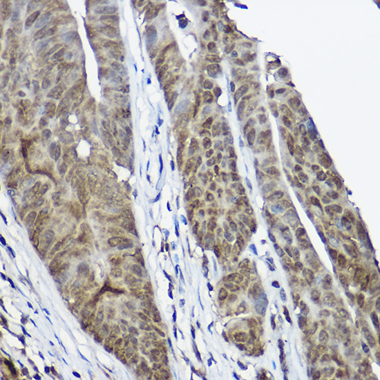 Immunohistochemistry of paraffin-embedded human colon carcinoma using CSTB Polyclonal Antibody at dilution of 1:100 (40x lens).Perform high pressure antigen retrieval with 10 mM citrate buffer pH 6.0 before commencing with IHC staining protocol.