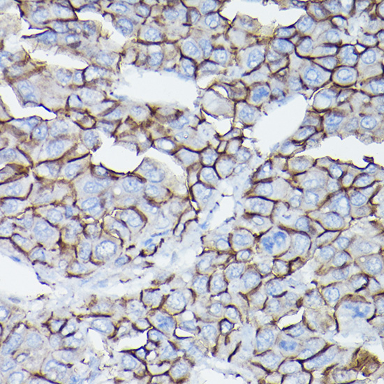 Immunohistochemistry of paraffin-embedded human liver cancer using [KO Validated] δ-Catenin/p120 Catenin Polyclonal Antibody at dilution of 1:50 (40x lens).Perform high pressure antigen retrieval with 10 mM citrate buffer pH 6.0 before commencing with IHC staining protocol.