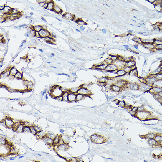 Immunohistochemistry of paraffin-embedded human prostate cancer using [KO Validated] δ-Catenin/p120 Catenin Polyclonal Antibody at dilution of 1:50 (40x lens).Perform high pressure antigen retrieval with 10 mM citrate buffer pH 6.0 before commencing with IHC staining protocol.