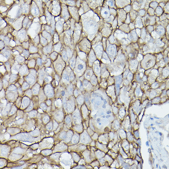 Immunohistochemistry of paraffin-embedded human urothelial carcinoma using [KO Validated] δ-Catenin/p120 Catenin Polyclonal Antibody at dilution of 1:50 (40x lens).Perform high pressure antigen retrieval with 10 mM citrate buffer pH 6.0 before commencing