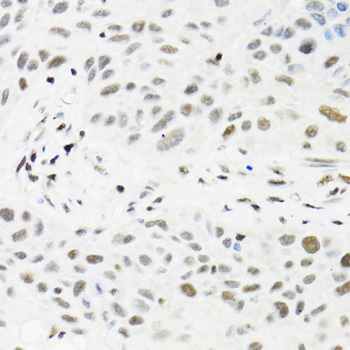 Immunohistochemistry of paraffin-embedded human lung cancer using TRMT2A/HTF9C Polyclonal Antibody at dilution of 1:100 (40x lens).Perform microwave antigen retrieval with 10 mM PBS buffer pH 7.2 before commencing with IHC staining protocol.