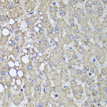 Immunohistochemistry of paraffin-embedded human liver damage using PIK3C2A Polyclonal Antibody at dilution of 1:100 (40x lens).Perform microwave antigen retrieval with 10 mM PBS buffer pH 7.2 before commencing with IHC staining protocol.