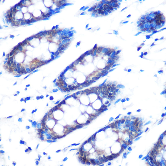 Immunohistochemistry of paraffin-embedded human colon using Rad23B Polyclonal Antibody at dilution of 1:100 (40x lens).Perform microwave antigen retrieval with 10 mM PBS buffer pH 7.2 before commencing with IHC staining protocol.