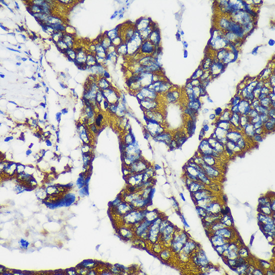 Immunohistochemistry of paraffin-embedded Human colon cancer using MAP2K4 Polyclonal Antibody at dilution of 1:100 (40x lens).Perform microwave antigen retrieval with 10 mM PBS buffer pH 7.2 before commencing with IHC staining protocol.