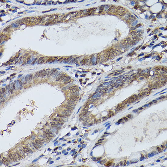 Immunohistochemistry of paraffin-embedded human colon carcinoma using [KO Validated] STAT5B Polyclonal Antibody at dilution of 1:100 (40x lens).Perform high pressure antigen retrieval with 10 mM citrate buffer pH 6.0 before commencing with IHC staining protocol.