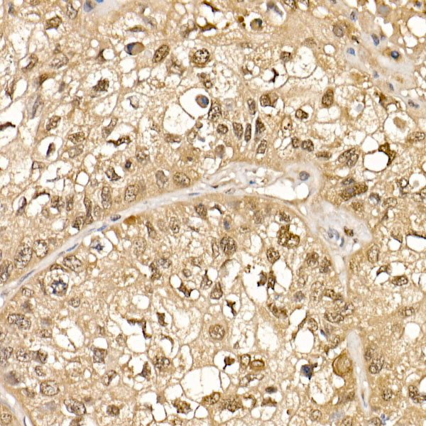 Immunohistochemistry of paraffin-embedded human lung cancer using Cullin 1 Polyclonal Antibody at dilution of 1:50 (40x lens).Perform high pressure antigen retrieval with 10 mM citrate buffer pH 6.0 before commencing with IHC staining protocol.