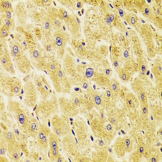 Immunohistochemistry of paraffin-embedded human liver damage using TXNL1 Polyclonal Antibody at dilution of 1:100 (40x lens).Perform microwave antigen retrieval with 10 mM PBS buffer pH 7.2 before commencing with IHC staining protocol.