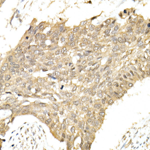 Immunohistochemistry of paraffin-embedded human esophageal cancer using hnRNP E1/PCBP1 Polyclonal Antibody at dilution of 1:100 (40x lens).Perform high pressure antigen retrieval with 10 mM citrate buffer pH 6.0 before commencing with IHC staining protocol.