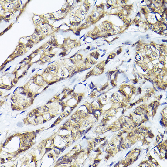 Immunohistochemistry of paraffin-embedded human breast cancer using Smad1 Polyclonal Antibody at dilution of 1:50 (40x lens).Perform high pressure antigen retrieval with 10 mM citrate buffer pH 6.0 before commencing with IHC staining protocol.