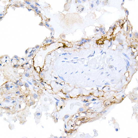 Immunohistochemistry of paraffin-embedded human lung using Podoplanin Polyclonal Antibody at dilution of 1:20 (40x lens).Perform high pressure antigen retrieval with 10 mM citrate buffer pH 6.0 before commencing with IHC staining protocol.