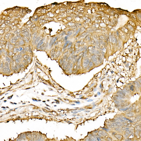 Immunohistochemistry of paraffin-embedded human colon carcinoma using Hsp90β Polyclonal Antibody at dilution of 1:20 (40x lens).Perform high pressure antigen retrieval with 10 mM citrate buffer pH 6.0 before commencing with IHC staining protocol.