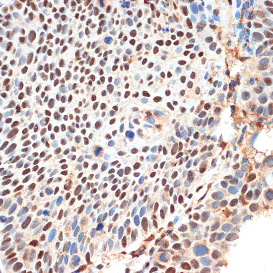 Immunohistochemistry of paraffin-embedded human esophageal cancer using KDM3B Polyclonal Antibody at dilution of 1:100 (40x lens).Perform microwave antigen retrieval with 10 mM Tris/EDTA buffer pH 9.0 before commencing with IHC staining protocol.